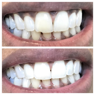 What-are-Cosmetic-Dental-Veneers-Teeth-Whitening-Lumineers